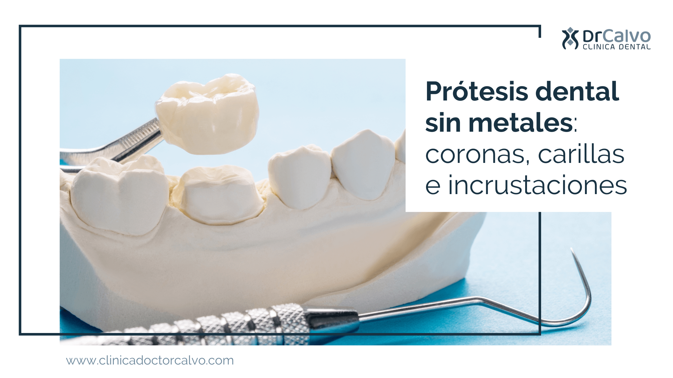 Prótesis dental sin metales: coronas, carillas e incrustaciones % %