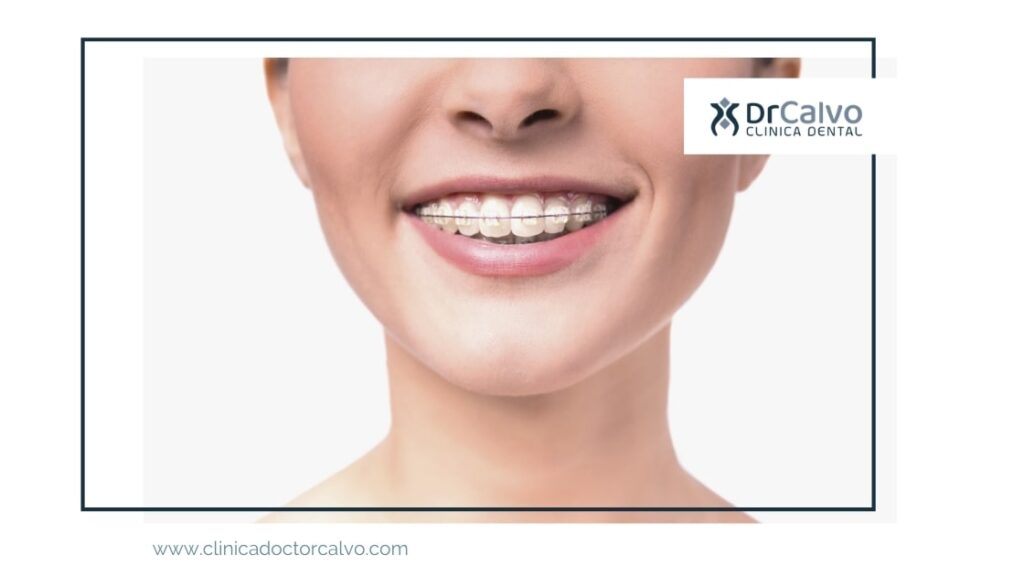 Brackets de zafiro los porqué de su alta estética Clínica Doctor