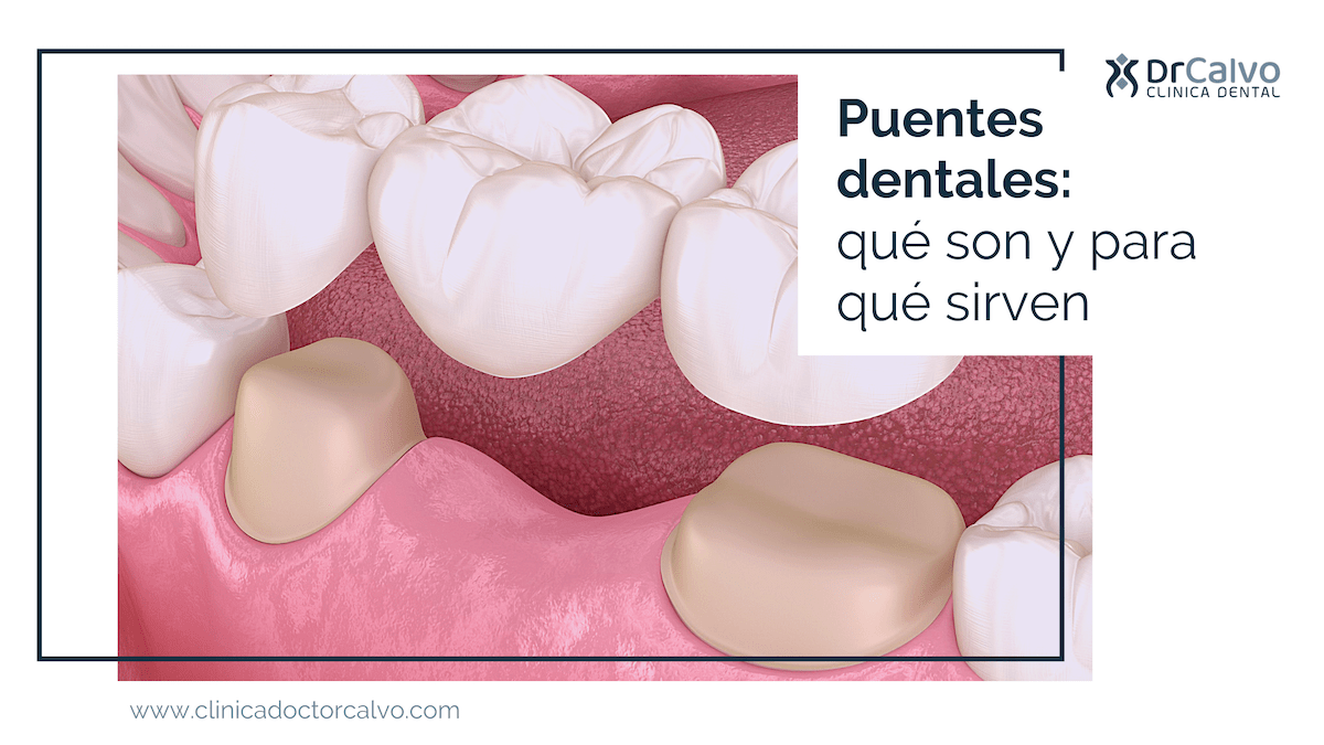 Prótesis dental sin metales: coronas, carillas e incrustaciones % %